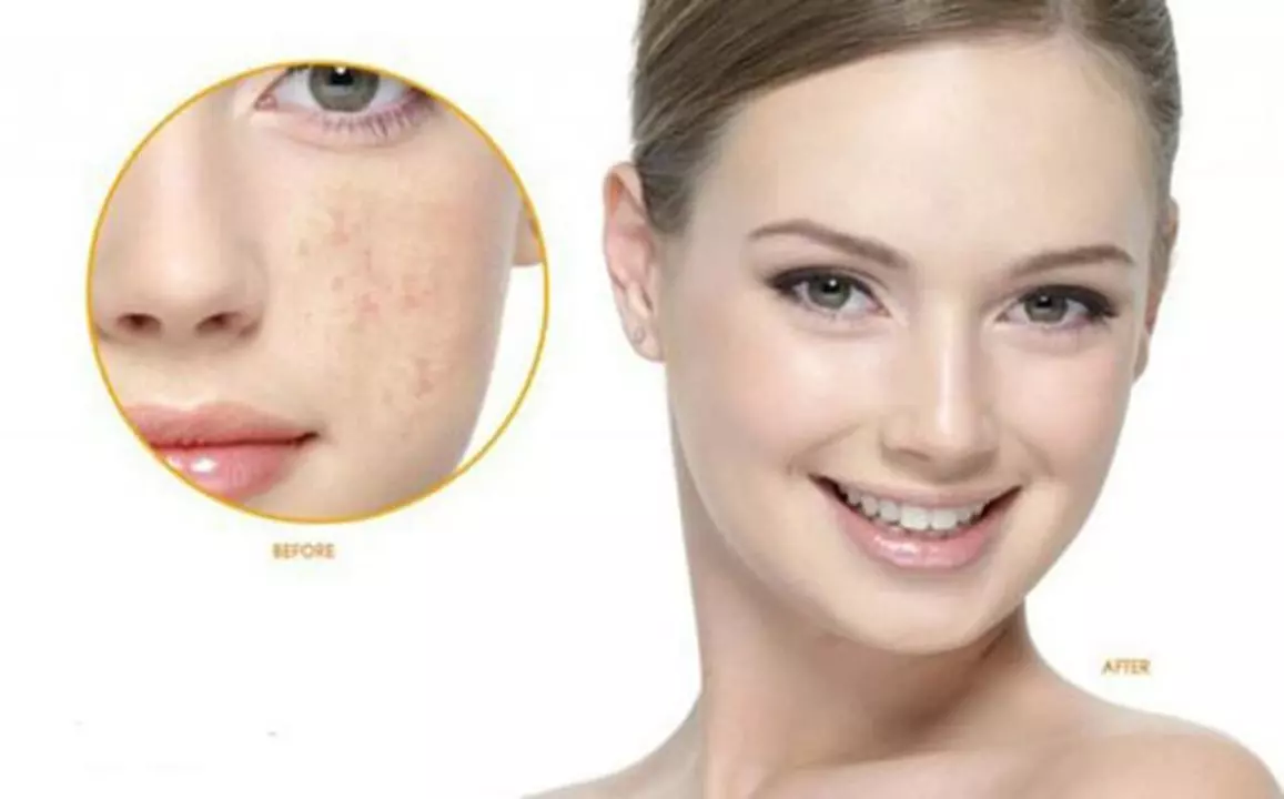 Melasma and Acne: How to Manage Both Skin Conditions