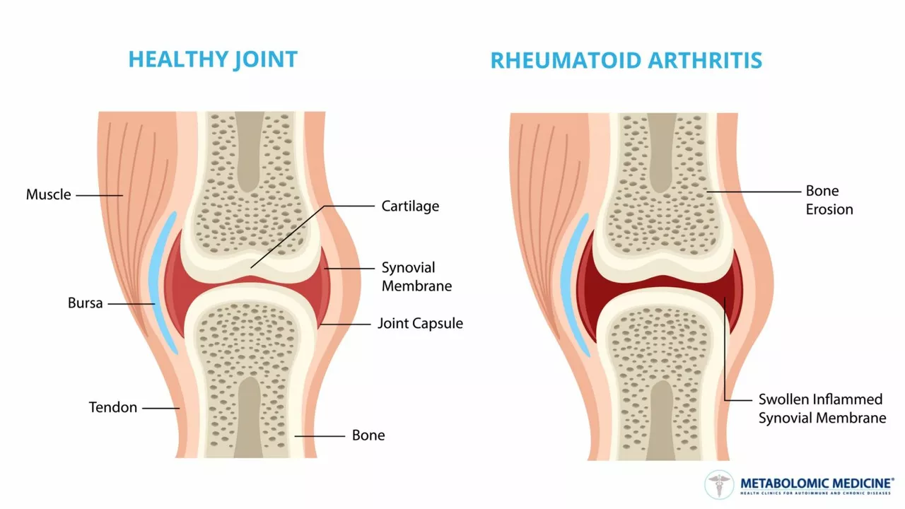 The Relationship Between Osteoporosis and Rheumatoid Arthritis